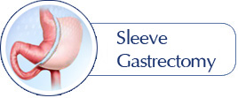 Sleeve Gastrectomy - Martin Obesity Surgery